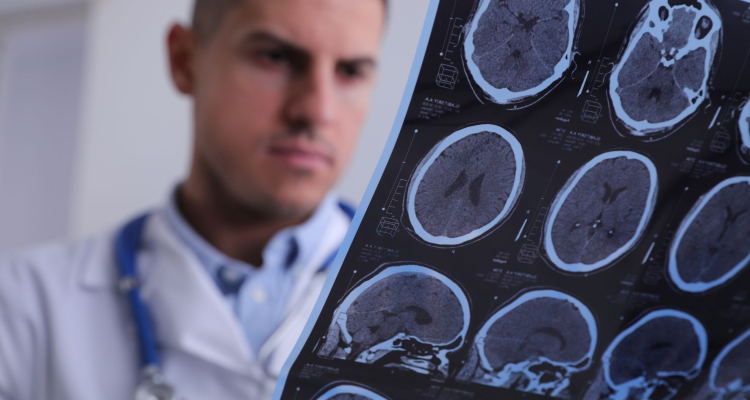 Epilepsija v Sloveniji ostaja stigmatizirana, sogovorniki poudarili več ozaveščanja